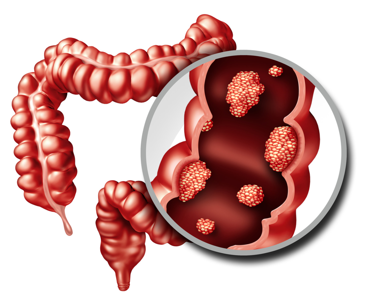 Gut Microbiome of Colorectal Cancer Patients