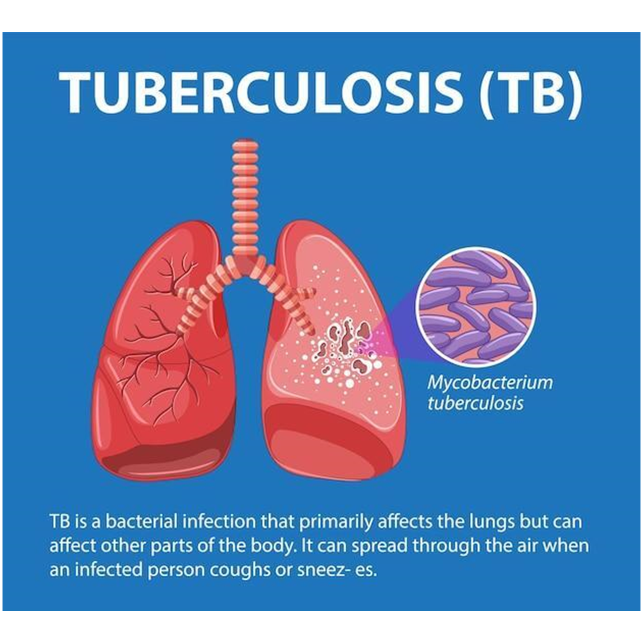 Gut Microbiome of Pulmonary Tuberculosis Patients