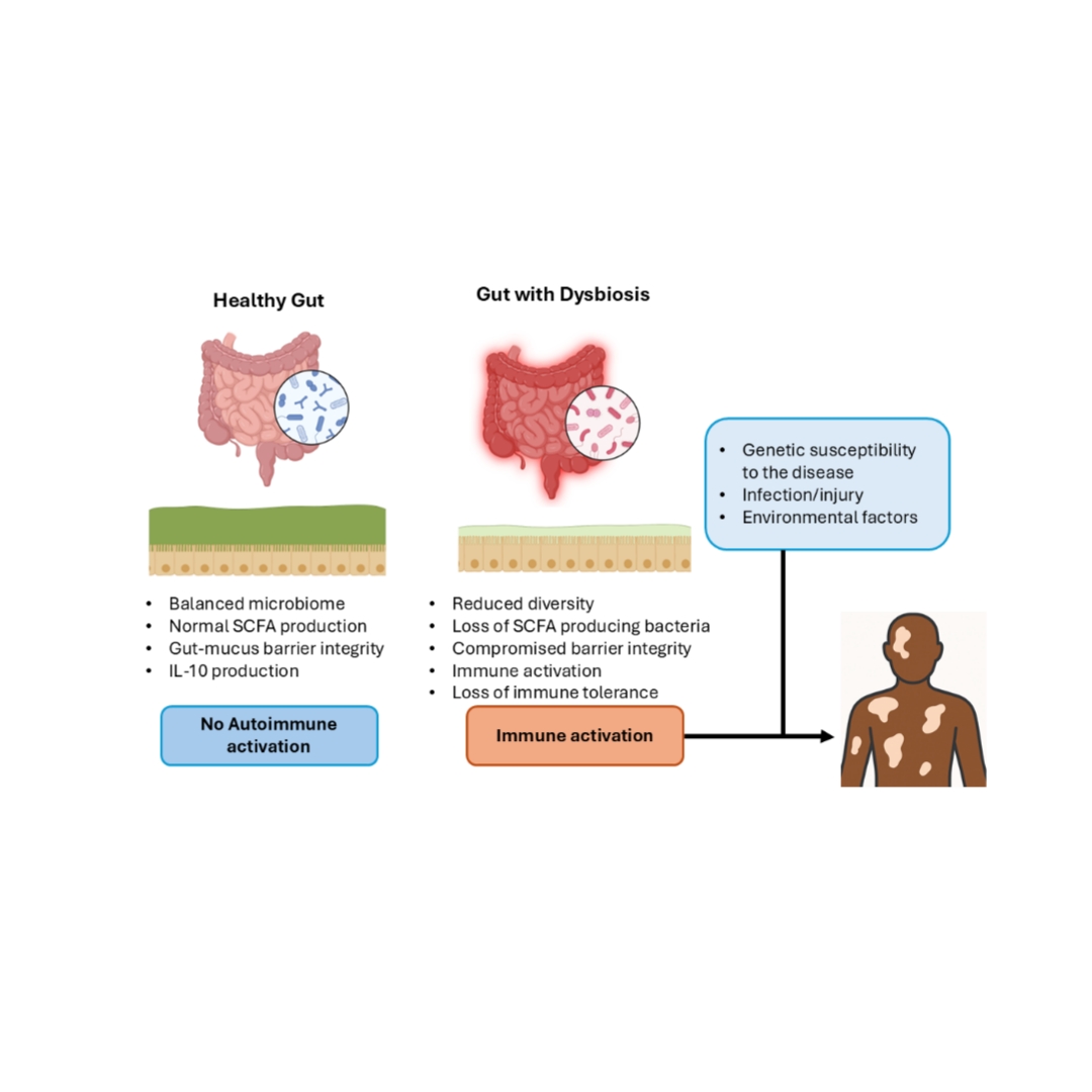 Gut Microbiome of Vitiligo Patients
